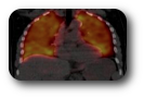 scintigraphie pulmonaire