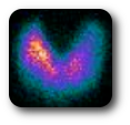 scintigraphie thyroide